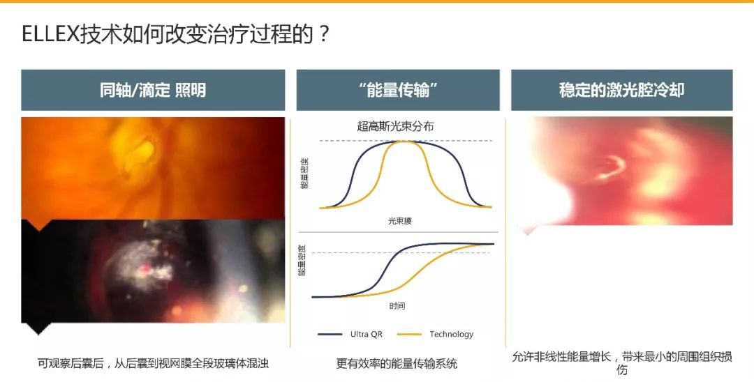 精准安全，无创无忧——UltraQReflex激光玻璃体消融术（LFR）