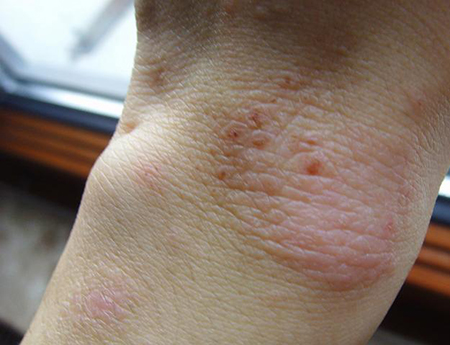 身上起湿疹不治疗会很严重吗