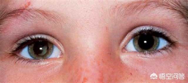 夺去王凤雅小朋友生命的视网膜母细胞瘤能治愈吗？