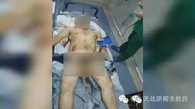济南男子被1米长钢筋从阴部穿到脑部30名专家开颅开胸开腹手术7小时保住命