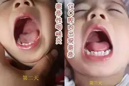 手足口病疱疹性咽峡炎如何防治,疱疹性咽峡炎的防治