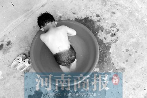 孩子患上罕见兽皮痣视频,新生儿巨型黑色素痣