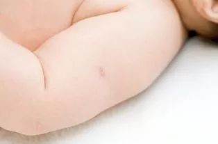 为什么疫苗打完后经常会痒,新生婴儿打卡介疫苗会化脓正常吗