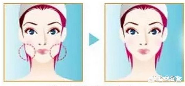 咬肌大脸颊凹适合瘦脸吗,下颌骨宽咬肌大如何瘦脸