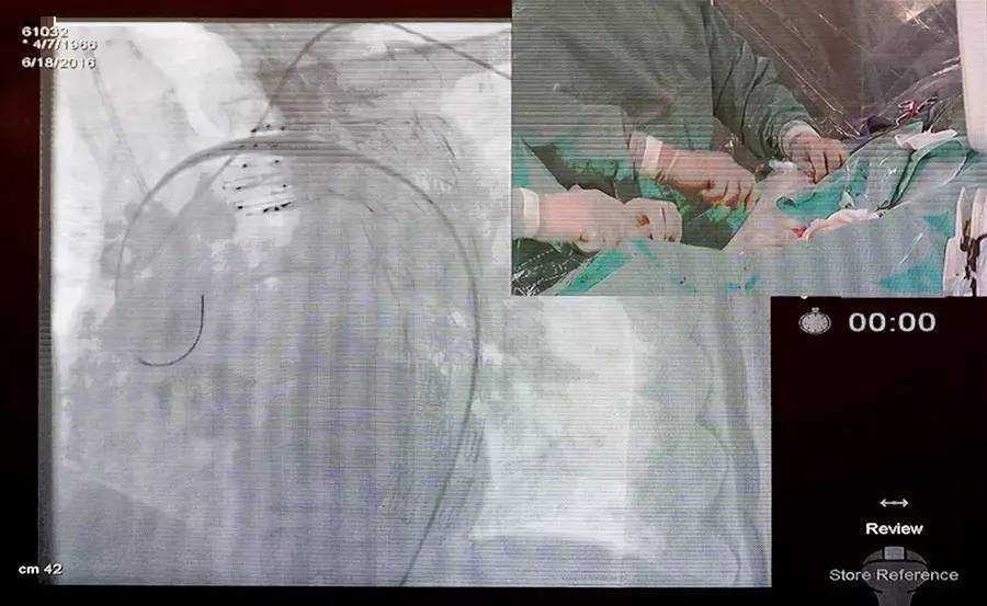 CCCPNCF2016勇攀高峰!主动脉夹层手术直播