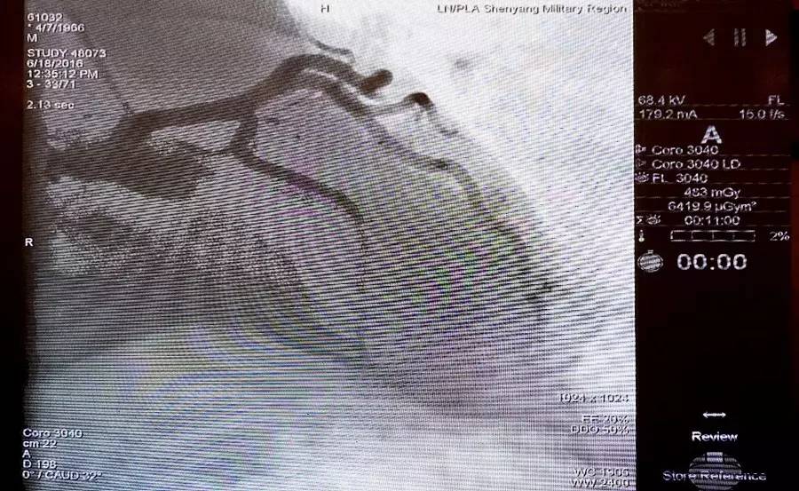 CCCPNCF2016勇攀高峰!主动脉夹层手术直播