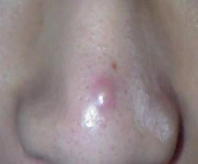 鼻子长痘痘怎么调理小妙招,鼻子长痘痘是上火吗