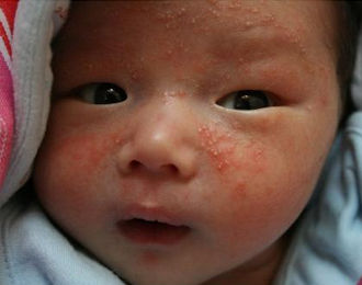 奶癣是吃母乳的原因吗,宝宝得了奶癣会传染的吗