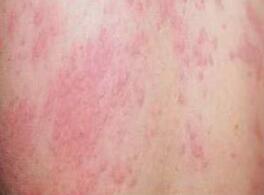 麻疹好了又得了荨麻疹,麻疹需要去医院吗