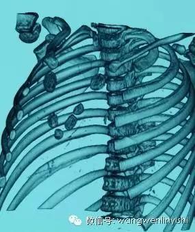 胸骨裂合并先心病的手术治疗