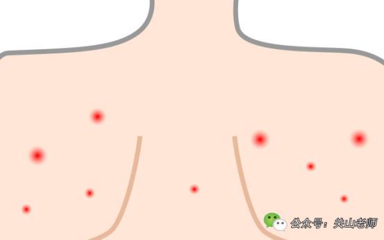 孩子身上都是小红疙瘩怎么回事,小孩身上无缘无故起了些红疙瘩