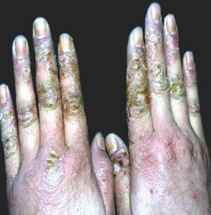 湿疹发作记住这些方法远离湿疹,湿疹很严重反反复复怎么治疗