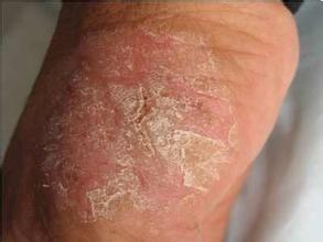 湿疹发作记住这些方法远离湿疹,湿疹很严重反反复复怎么治疗