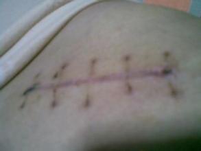 他手术后刀口化脓排出丝线，医生说和他的体质有关。