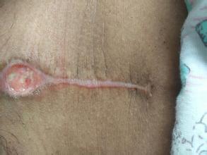 他手术后刀口化脓排出丝线，医生说和他的体质有关。