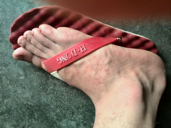 你被蚊子咬了吗是什么梗,四川墨蚊咬了以后怎么治疗