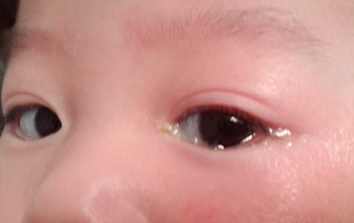 小孩子眼睛有很多眼屎是怎么回事,宝宝眼睛上火起眼屎用什么药