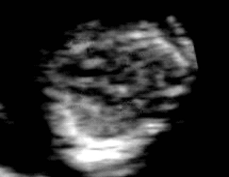 早期妊娠超声主要检查指标视频,输卵管妊娠的超声表现