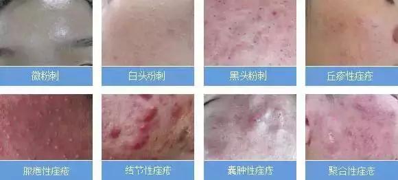 痘痘发炎红肿多久能消退,痘痘发炎红肿怎么办要割掉吗