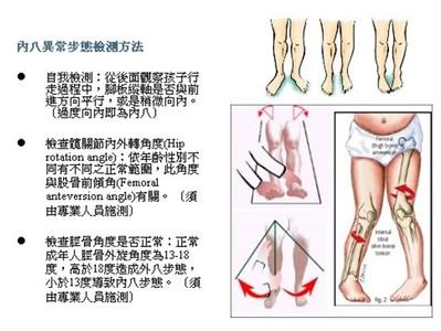 宝宝怎样才能学会罗圈腿,宝宝罗圈腿最佳治疗方法