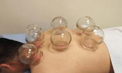 中医拔罐疗法技术,这才是最有效的中医疗法