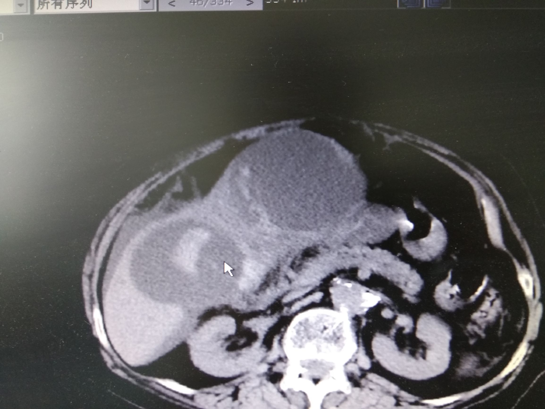 她因为诊断肝囊肿反复穿刺抽液，最后却被证实是癌。
