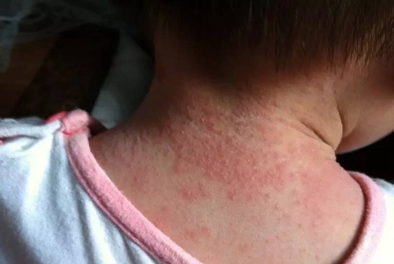 一身痱子图片,满身的痱子怎么治