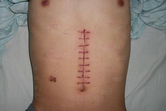 缝合伤口痒是怎么回事,切口愈合后变硬是怎么回事