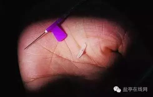 全面停止输液,全面停止门诊静脉输液坏处