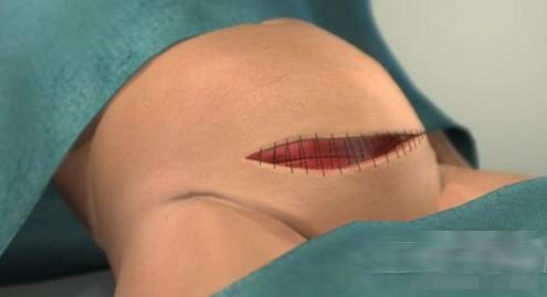 剖腹产的女人请好好珍惜,剖腹产女人要受多少罪