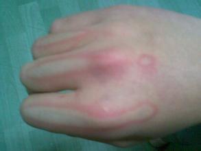 冬季取暖小心烫伤,暖气烫伤怎么处理好得快