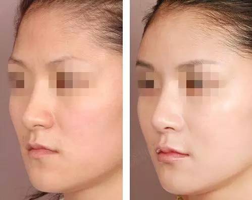 站在鼻整形塔尖的男人——亚洲鼻王曾高加盟*疆新**华美