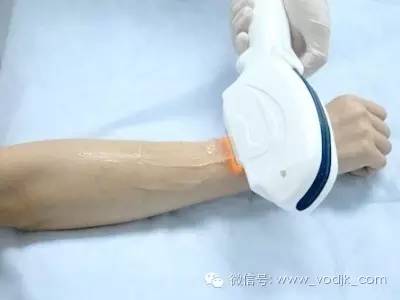 激光脱毛是永久的吗,激光脱毛仪真的可以永久脱毛吗