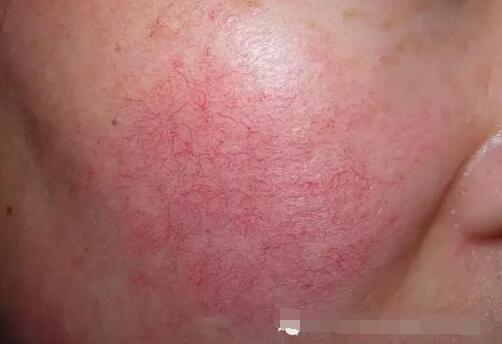 面部总是发红怎么办,面部总是泛红是怎么一回事