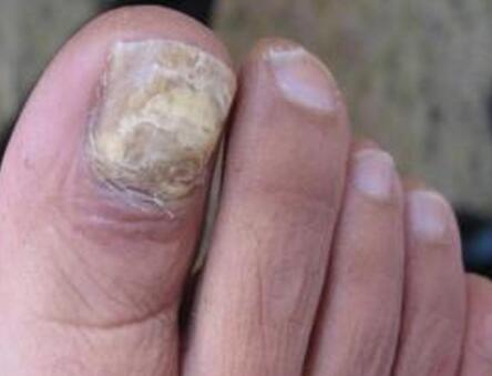 灰指甲一直修会好吗,灰指甲反反复复怎么办