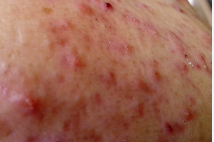 痘痘肌怎么去粉刺闭口,痘痘肌怎么去螨虫