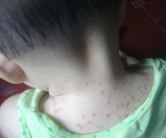 宝宝长痱子什么方法治最好,宝宝长痱子用什么方法最有效