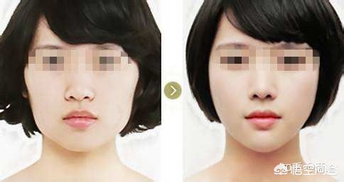 咬肌大脸颊凹适合瘦脸吗,下颌骨宽咬肌大如何瘦脸