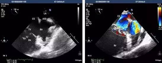 房颤患者做食道超声,做房颤手术之前一定要做食道镜吗