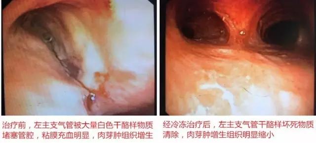 高端丨支气管结核居然能被这个德国来的机器“活活冻死”