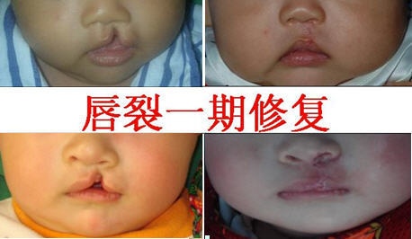 新生儿轻微兔唇是怎么造成的,怎么预防兔唇等缺陷