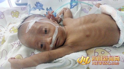眉山30周早产儿,四川省医院早产儿救治率