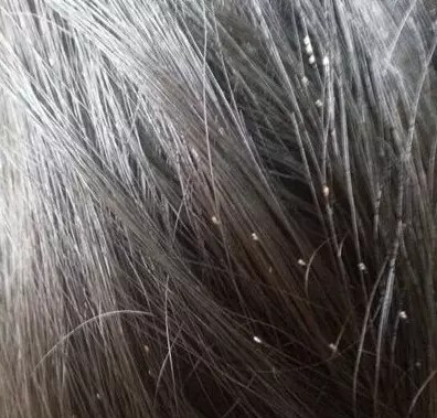 头上长虱子了，那可不是闹着玩的