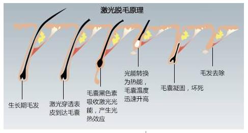 家用光学脱毛仪选购指南