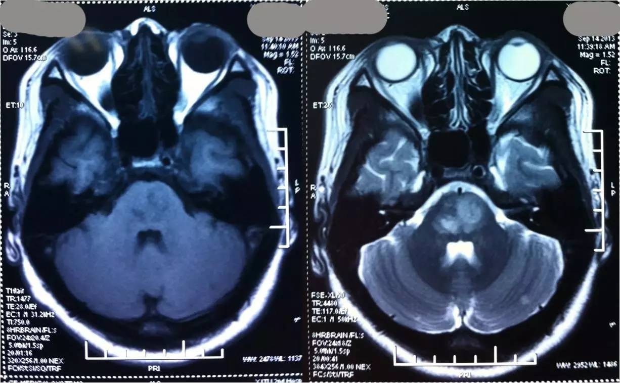 rt-pa溶栓的禁忌症,神经介入溶栓术联合静脉溶栓治疗