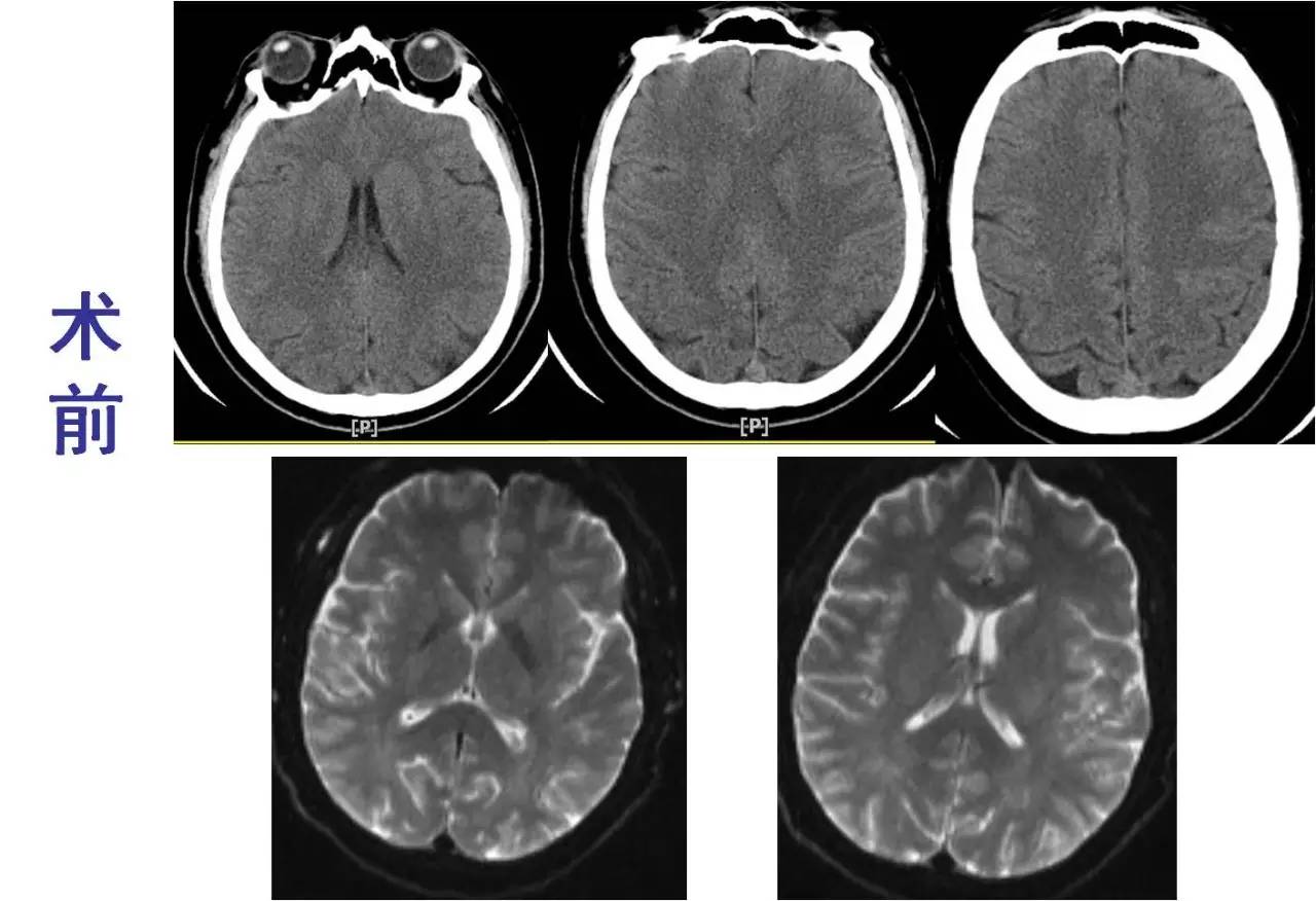 rt-pa溶栓的禁忌症,神经介入溶栓术联合静脉溶栓治疗