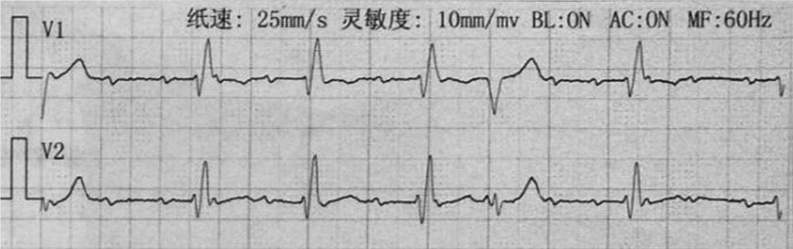 严重的3度房室传导阻滞致死率,iii度房室传导阻滞发病原因