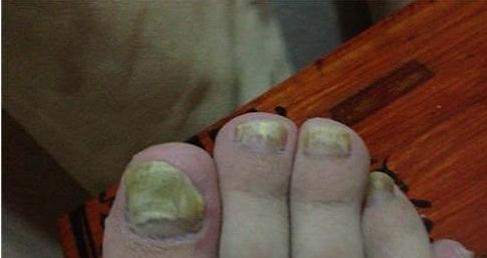 脚趾灰指甲对身体有什么危害,灰指甲烂到根部不治疗有什么危害