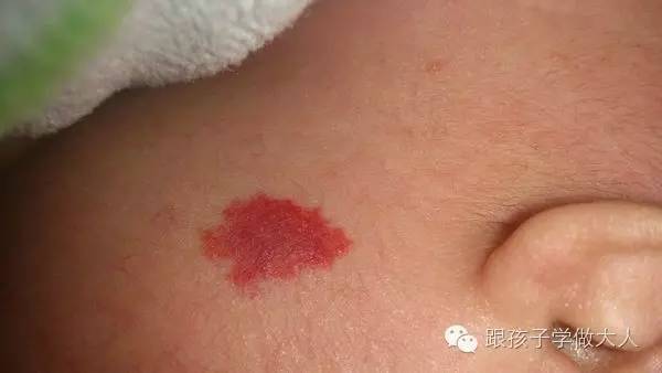 宝宝长雀斑样痣,宝宝长这种痣千万要关注
