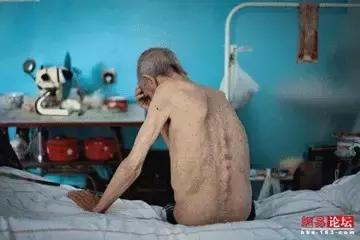 中医药预防肺结核病复发